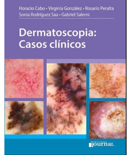 Dermatoscopia: Casos clínicos