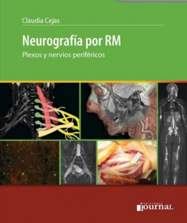 Neurografía por RM