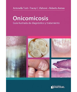 Onicomicosis